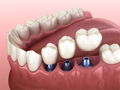 Dr. Raj Dental Clinic Services