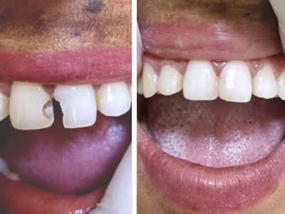 Diastema Closure with Composite.