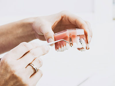 Dental Implants Dr. Raj Dental Clinic