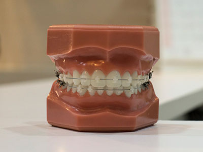 Orthodontics / Braces Dr. Raj Dental Clinic