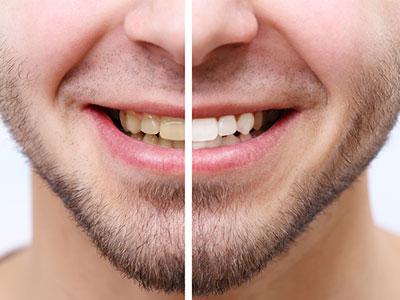 Instant Teeth Whitening Dr. Raj Dental Clinic